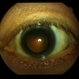 Normal Eye Normal Eye
